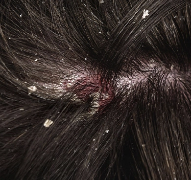 Those experiencing itchy, dry, or inflamed scalp