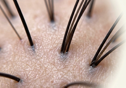 Follicular Unit Pattern