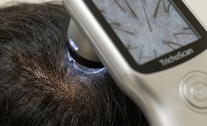 Laser Hair Removal Treatment