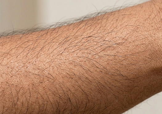 Acquired Hypertrichosis