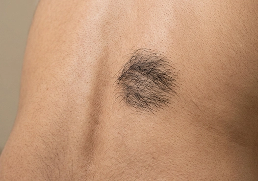 Localised Hypertrichosis