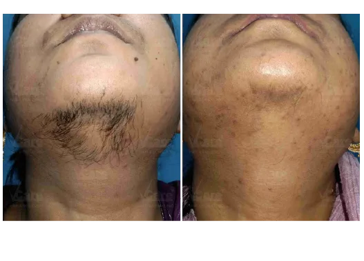 Before & After Laser Hair Removal Treatment Results