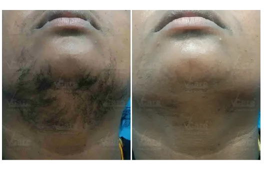 Before & After Laser Hair Removal Treatment Results