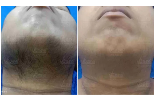 Before & After Laser Hair Removal Treatment Results