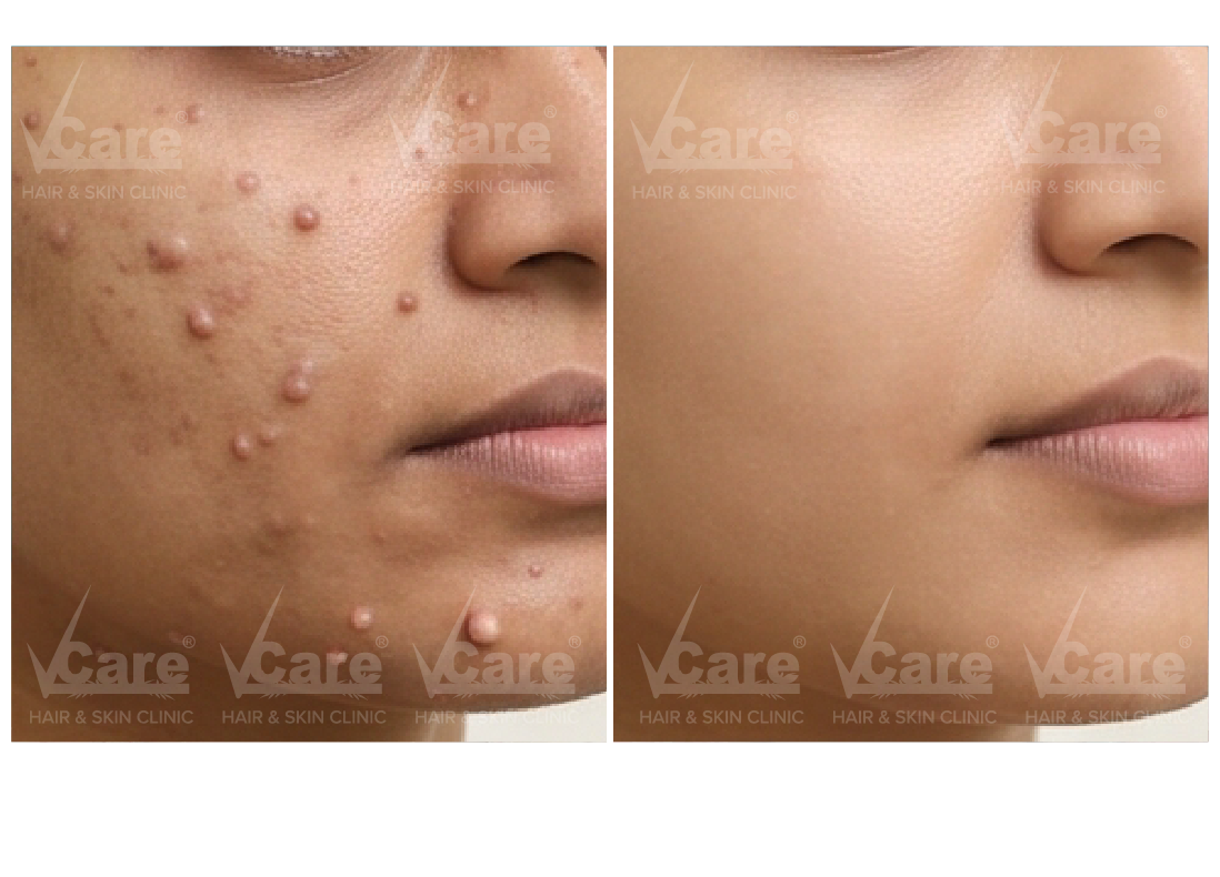 Before & After Wart Removal Treatment Results