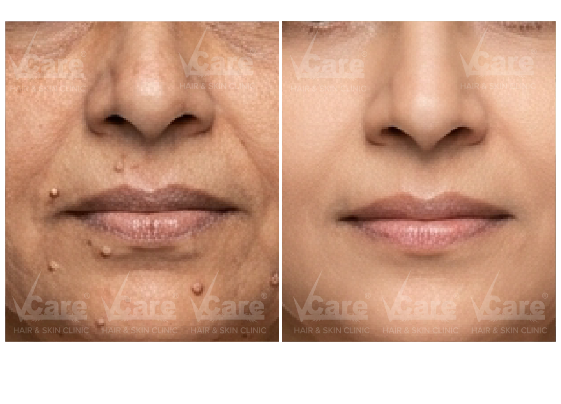 Before & After Wart Removal Treatment Results