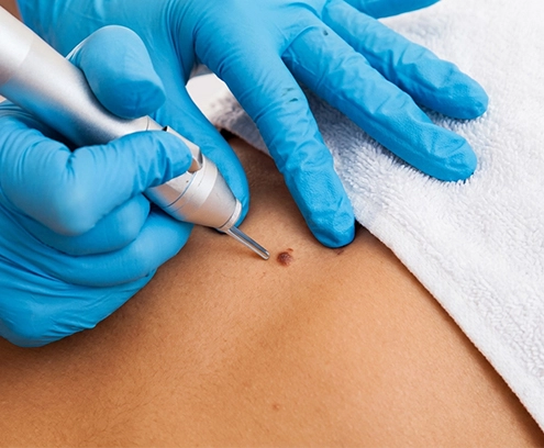 Electro Cauterization Technology (for warts that can be held with a tweezer)