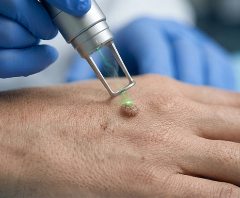 RF Cautery Technology (for surface-level warts)