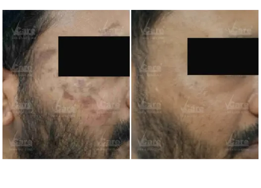 Yellow Peel Treatment Before and After