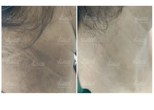 Yellow Peel Treatment Before and After