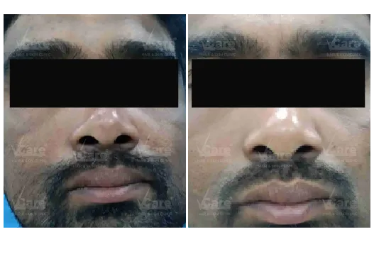Yellow Peel Treatment Before and After