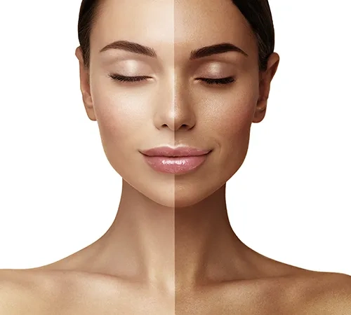 Carbon peel for a fair skin