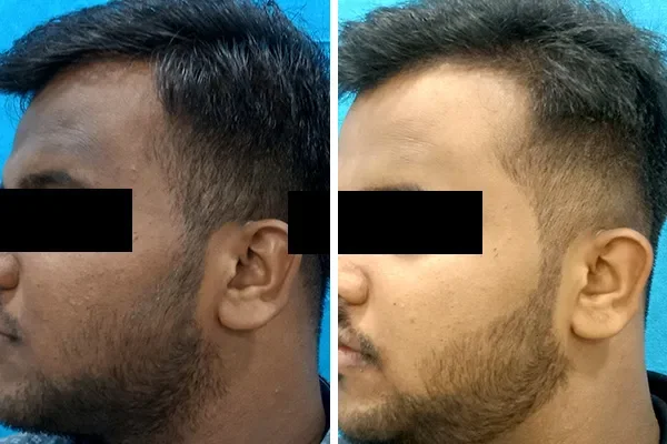 Acne Scar removal treatment