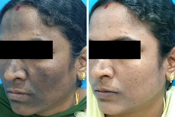 Flaunt your skin with Vcare