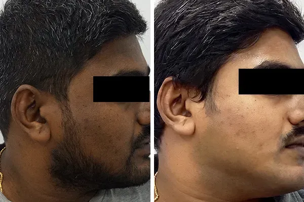 Laser Hair Removal Treatment