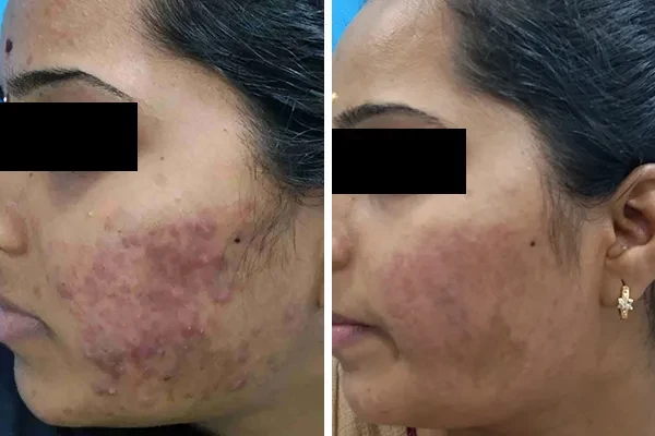 Laser Hair Removal Treatment